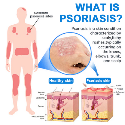 USA 80%OFF✅Official Store: Zvoevo®Magnesium Herbal Psoriasis Spray⚕️FDA Certified (Eliminates psoriasis and eczema, treats bacterial infections in the genital area, relieves joint pain and neuropathic pain, and treats acne and pigmentation) (Copy)