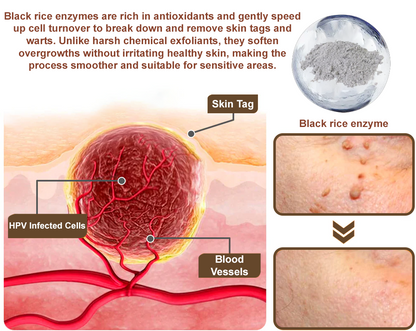 Zvoevo® Black Rice Essence Cream👨‍⚕️ FDA Certified (Removes Skin Growths and Warts, Improves Actinic Keratosis and Purpura, Skin Cancer and Age Spots)