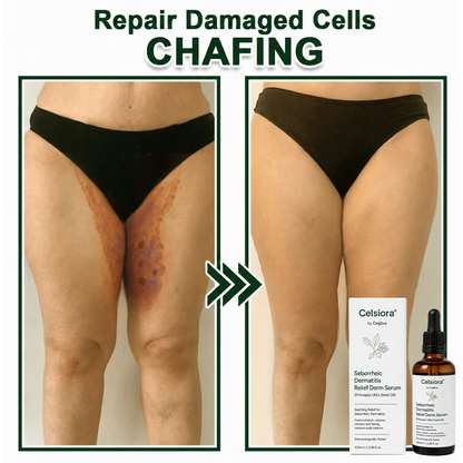 upsell💚Celsiora® Seborrheic Dermatitis Relief Derm Serum