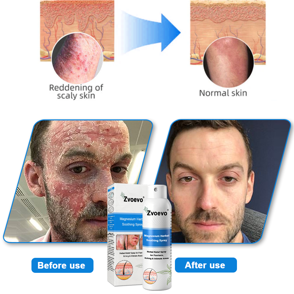 USA 80%OFF✅Official Store: Zvoevo®Magnesium Herbal Psoriasis Spray⚕️FDA Certified (Eliminates psoriasis and eczema, treats bacterial infections in the genital area, relieves joint pain and neuropathic pain, and treats acne and pigmentation) (Copy)