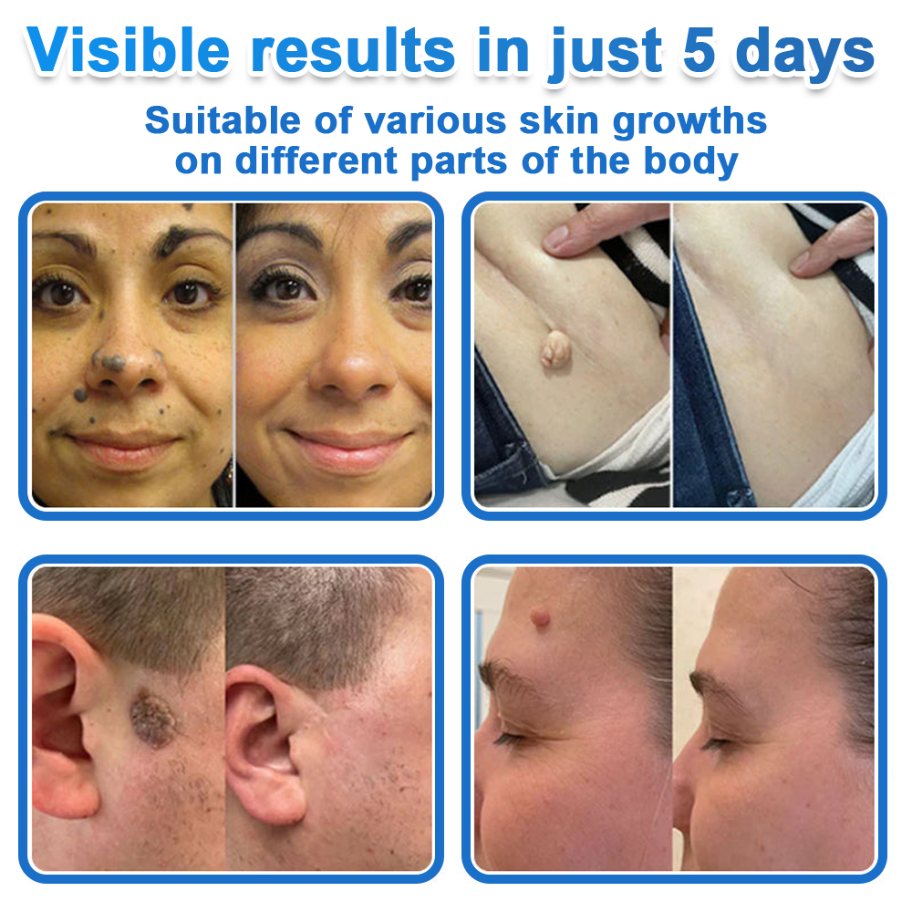 ✅ Celsiora® 2-in-1 Microneedle & Hydrocolloid Patch | Raised Moles,Acne,  Flat Warts & Skin Tags Remover | Improves Wrinkles, Scars & Blemishes | Invisible Pimple Patches for Face & Body