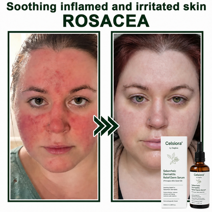🟢Celsiora® Seborrheic Dermatitis Relief Derm Serum