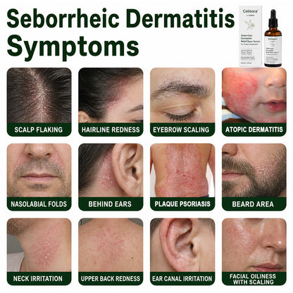 🟢Celsiora® Seborrheic Dermatitis Relief Derm Serum