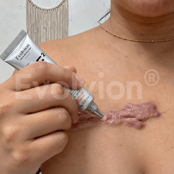 Evolviion GF² Advanced Bioactive Scar Repair Gel👨‍⚕️(For Hypertrophic Scars/Post-Surgical Scars/Stretch Marks/Acne Scars)