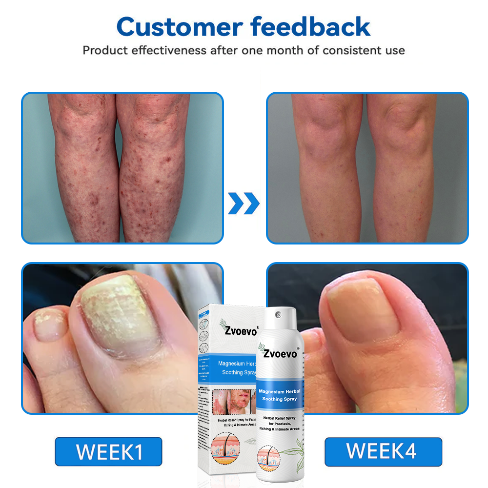 USA 80%OFF✅Official Store: Zvoevo®Magnesium Herbal Psoriasis Spray⚕️FDA Certified (Eliminates psoriasis and eczema, treats bacterial infections in the genital area, relieves joint pain and neuropathic pain, and treats acne and pigmentation) (Copy)