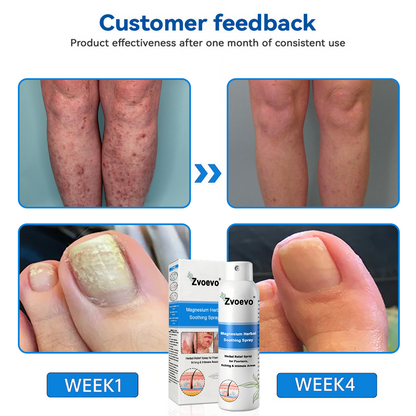 USA 80%OFF✅Official Store: Zvoevo®Magnesium Herbal Psoriasis Spray⚕️FDA Certified (Eliminates psoriasis and eczema, treats bacterial infections in the genital area, relieves joint pain and neuropathic pain, and treats acne and pigmentation) (Copy)