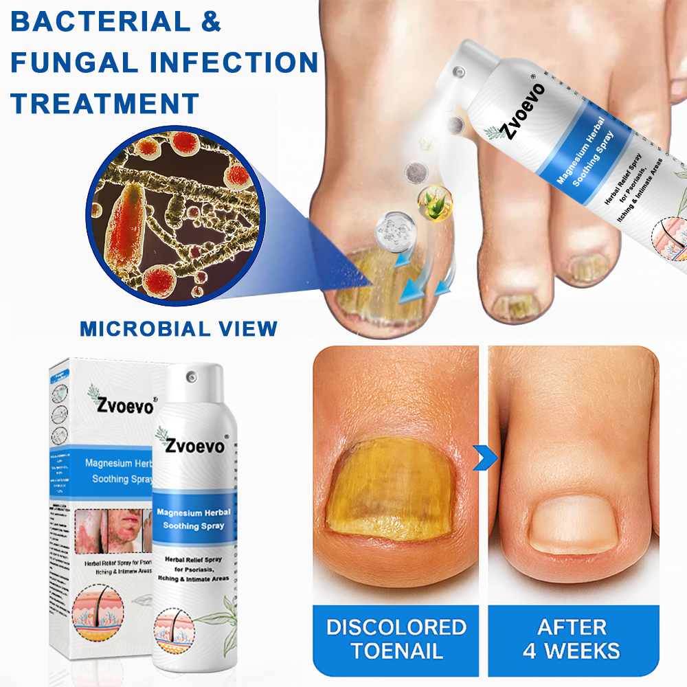 USA 80%OFF✅Official Store: Zvoevo®Magnesium Herbal Psoriasis Spray⚕️FDA Certified (Eliminates psoriasis and eczema, treats bacterial infections in the genital area, relieves joint pain and neuropathic pain, and treats acne and pigmentation) (Copy)