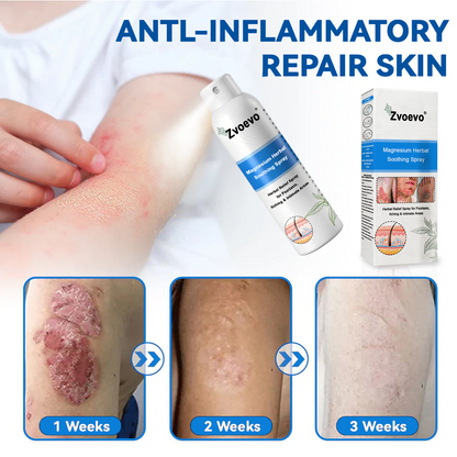 USA 80%OFF✅Official Store: Zvoevo®Magnesium Herbal Psoriasis Spray⚕️FDA Certified (Eliminates psoriasis and eczema, treats bacterial infections in the genital area, relieves joint pain and neuropathic pain, and treats acne and pigmentation) (Copy)