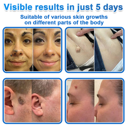 ✨Celsiora® 2-in-1 Microneedle & Hydrocolloid Patch | Raised Moles,Acne,  Flat Warts & Skin Tags Remover | Improves Wrinkles, Scars & Blemishes | Invisible Pimple Patches for Face & Body