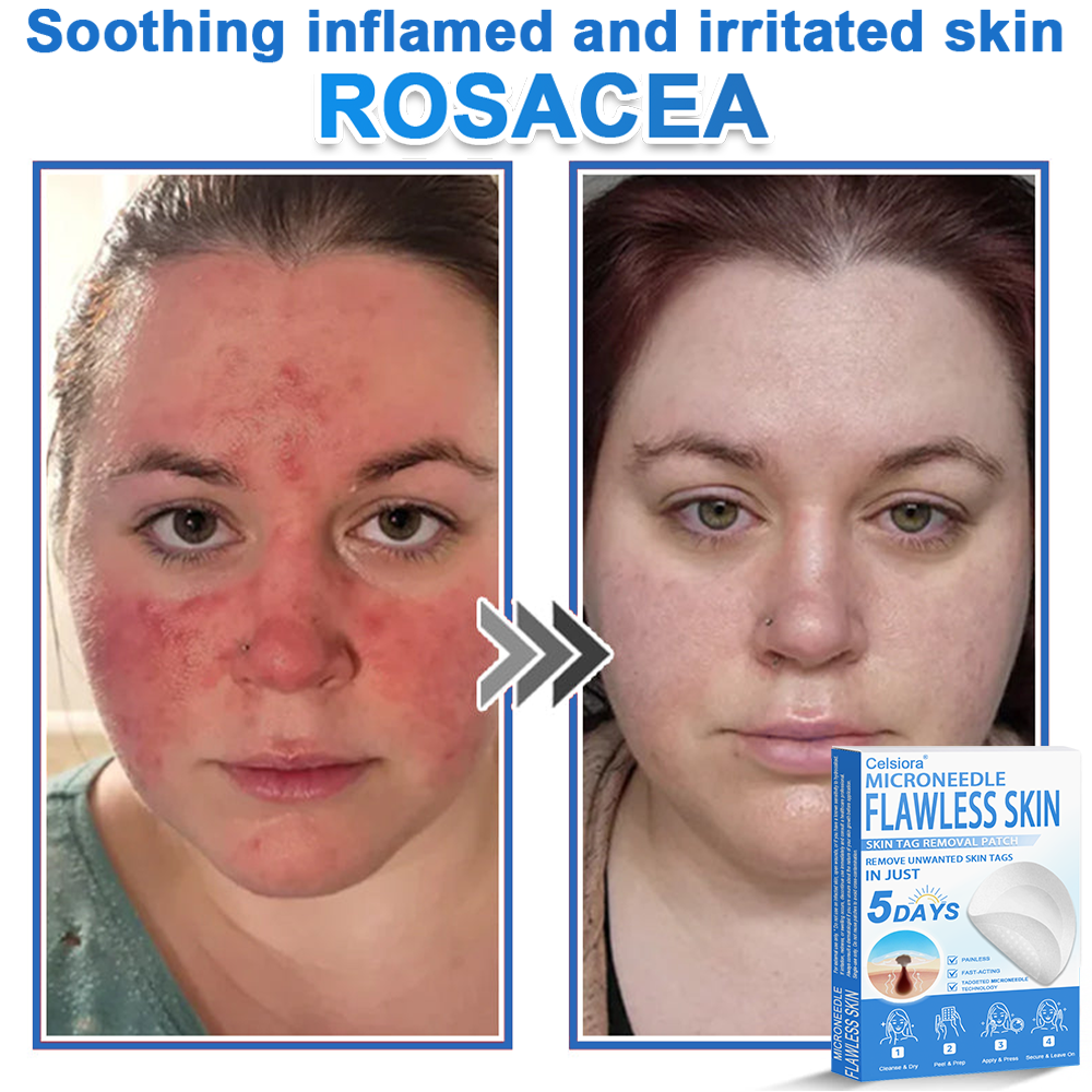 ✨Celsiora® 2-in-1 Microneedle & Hydrocolloid Patch | Raised Moles,Acne,  Flat Warts & Skin Tags Remover | Improves Wrinkles, Scars & Blemishes | Invisible Pimple Patches for Face & Body