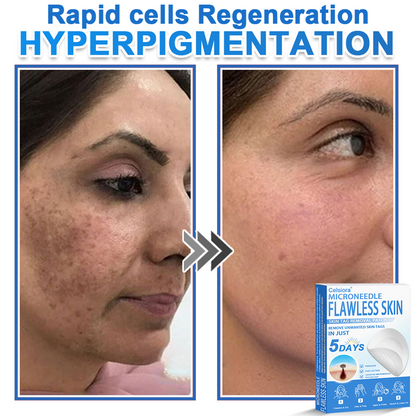 ✨Celsiora® 2-in-1 Microneedle & Hydrocolloid Patch | Raised Moles,Acne,  Flat Warts & Skin Tags Remover | Improves Wrinkles, Scars & Blemishes | Invisible Pimple Patches for Face & Body