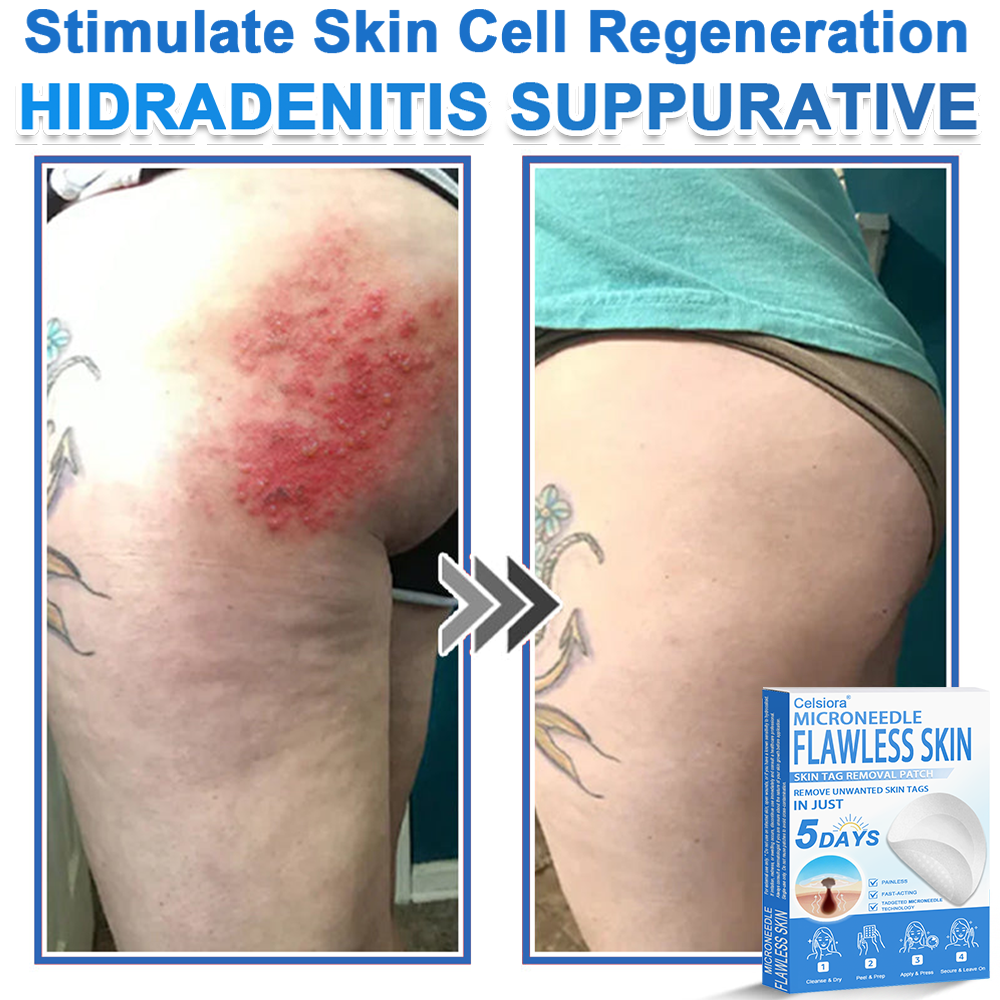 ✨Celsiora® 2-in-1 Microneedle & Hydrocolloid Patch | Raised Moles,Acne,  Flat Warts & Skin Tags Remover | Improves Wrinkles, Scars & Blemishes | Invisible Pimple Patches for Face & Body