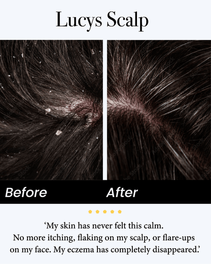 🟢Celsiora® Seborrheic Dermatitis Relief Derm Serum
