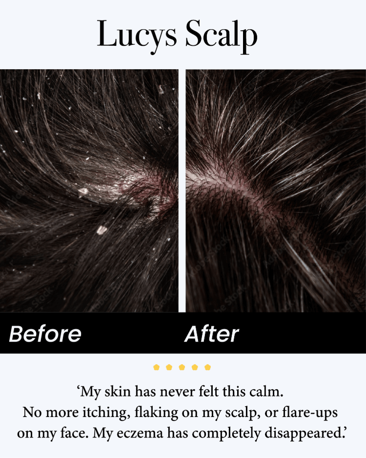 upsell💚Celsiora® Seborrheic Dermatitis Relief Derm Serum